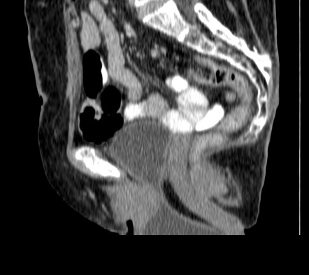 Bladder Prolapse Radiology Case Radiopaedia Org