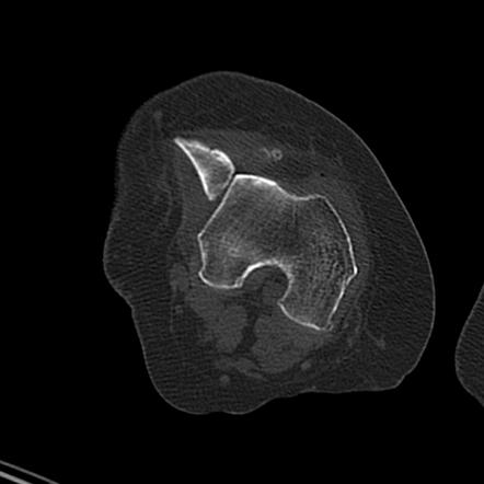 Traumatic patellar luxation | Radiology Case | Radiopaedia.org