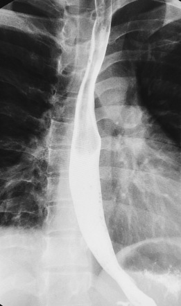 Normal barium swallow | Image | Radiopaedia.org