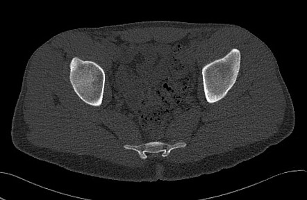 Brodie abscess - femoral neck | Radiology Case | Radiopaedia.org