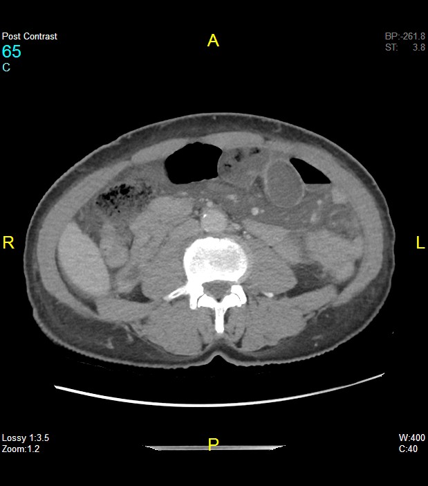 Postgastric bypass internal hernia Image