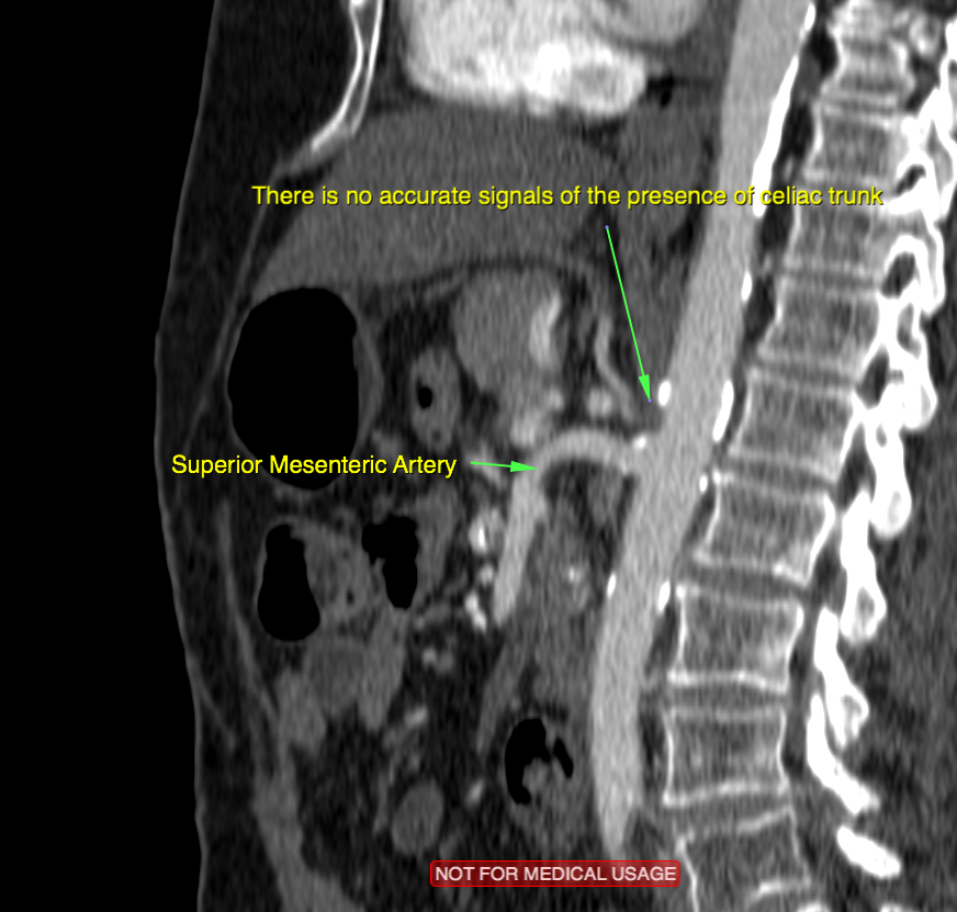 Rudimentary Celiac Artery With Collaterals Through Gastroduodenal Artery Image