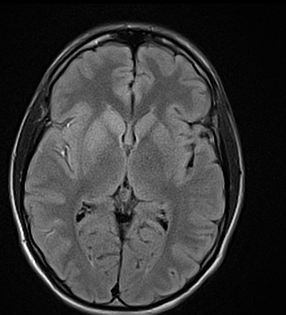 Right MCA infarction with thrombectomy | Image | Radiopaedia.org