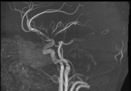 Right MCA infarction with thrombectomy | Image | Radiopaedia.org