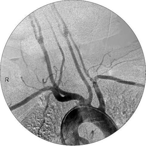 Bovine aortic arch | Image | Radiopaedia.org