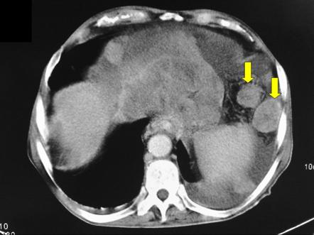 Hepatocellular carcinoma with peritoneal metastasis | Radiology Case ...