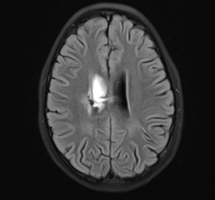 Intraventricular Hemorrhage Adult