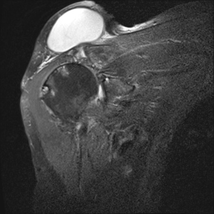 Geyser sign (shoulder) | Radiology Reference Article | Radiopaedia.org