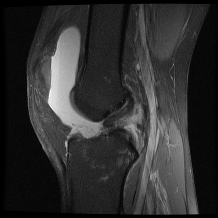 Segond fracture associated with ACL full thickness tear | Image ...