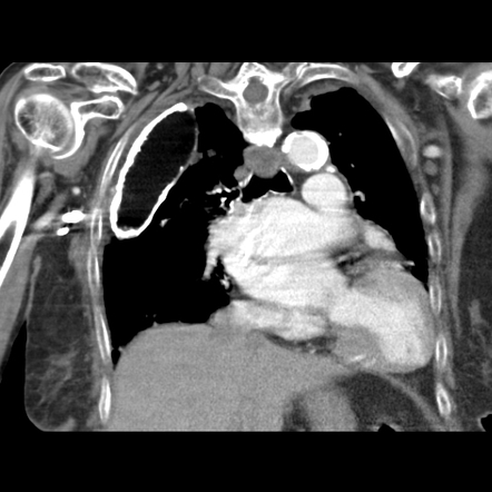 Oleothorax | Image | Radiopaedia.org