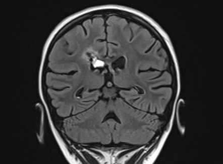 Intraventricular Hemorrhage | Image | Radiopaedia.org