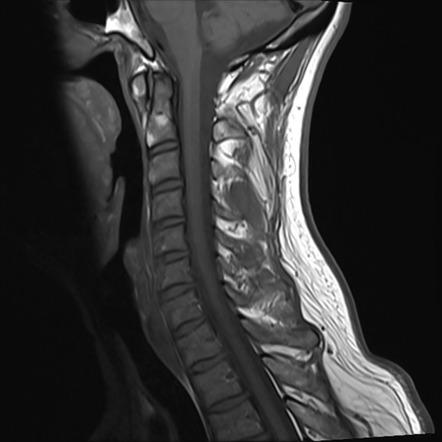 Normal MRI cervical spine - infection protocol | Radiology Case ...