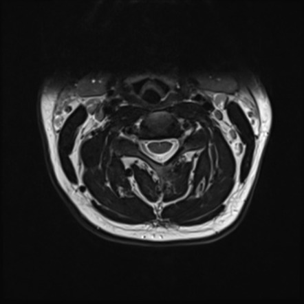 Normal MRI cervical spine - infection protocol | Image | Radiopaedia.org