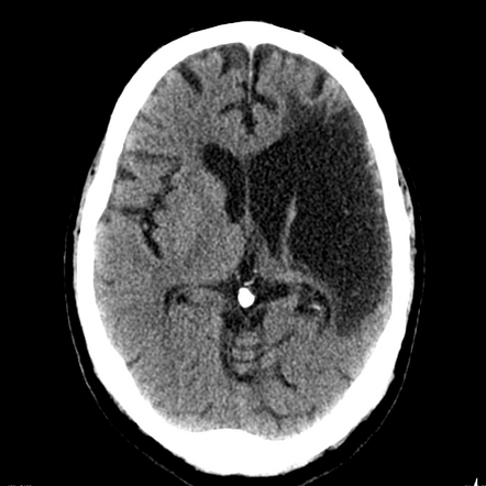 Encephalomalacia | Radiology Reference Article | Radiopaedia.org