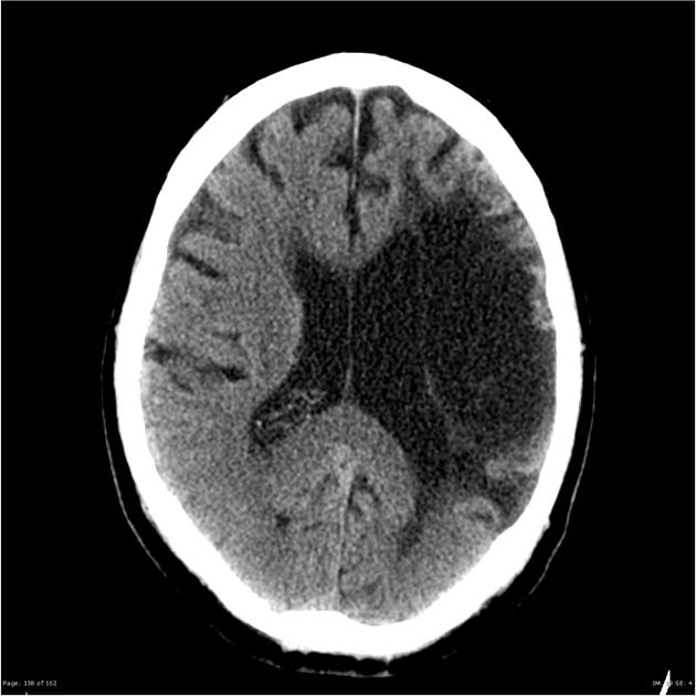 Encephalomalacia Radiology Case Radiopaedia Org