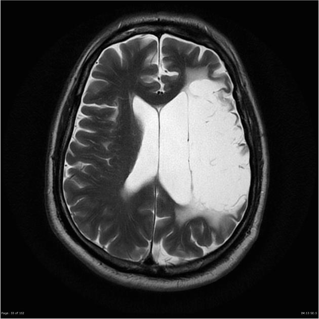 Encephalomalacia Radiology Case Radiopaedia Org