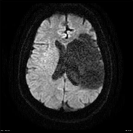 Encephalomalacia | Image | Radiopaedia.org