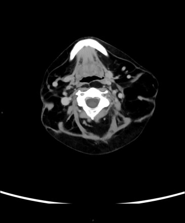 Madelung disease | Radiology Reference Article | Radiopaedia.org