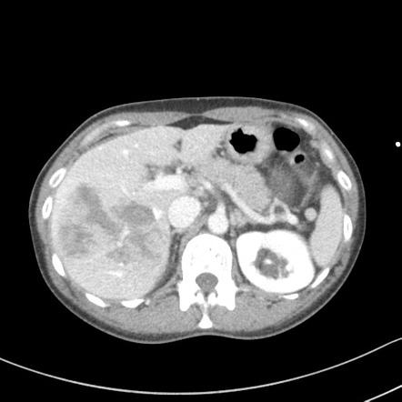 Liver laceration - AAST grade V | Image | Radiopaedia.org