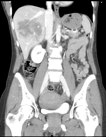 Liver laceration - AAST grade V | Image | Radiopaedia.org