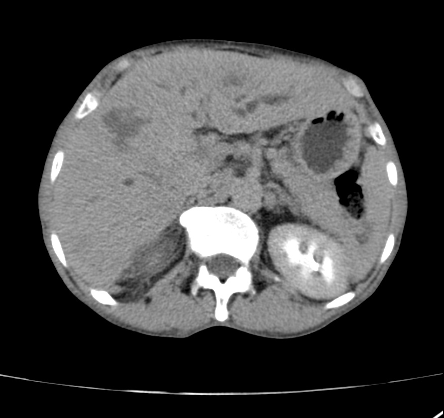 Gallbladder Carcinoma | Image | Radiopaedia.org