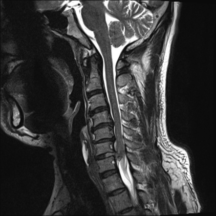 Cervical disc extrusion | Image | Radiopaedia.org