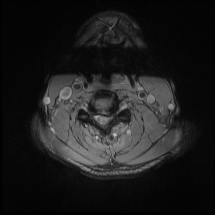 Cervical disc extrusion | Image | Radiopaedia.org