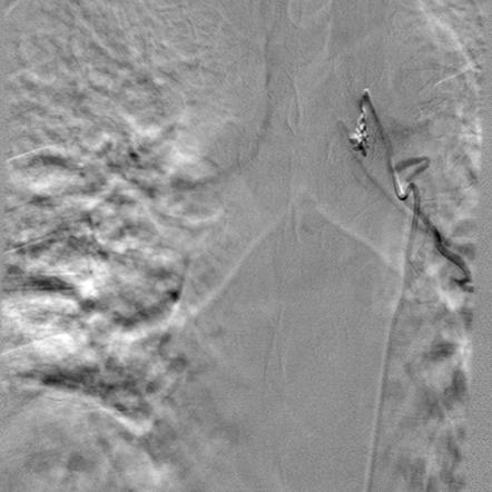 Bronchial arterial aneurysm | Image | Radiopaedia.org