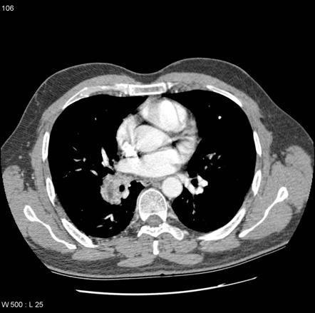 Bronchial arterial aneurysm | Radiology Case | Radiopaedia.org