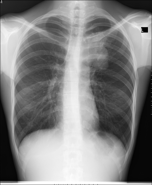 Congenital cystic adenomatoid malformation with partial anomalous ...