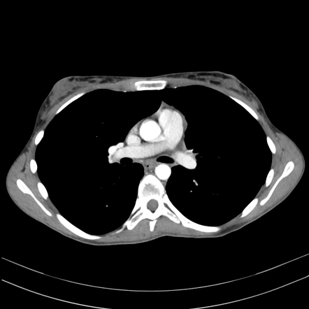 Congenital cystic adenomatoid malformation with partial anomalous ...