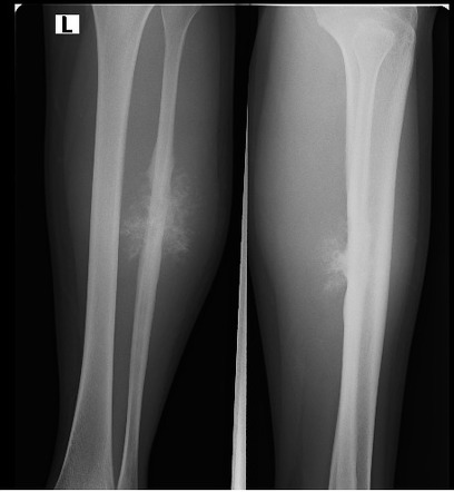 Osteosarcoma of the fibula with sun burst appearance | Radiology Case ...