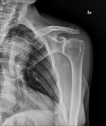 Milwaukee shoulder | Radiology Reference Article | Radiopaedia.org