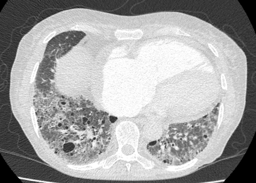 Usual interstitial pneumonia | Image | Radiopaedia.org