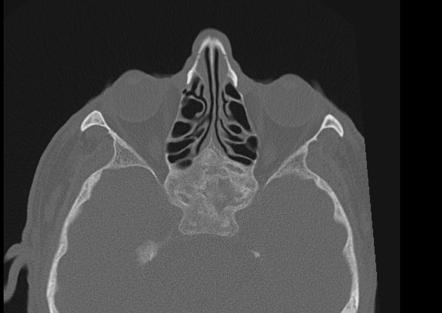 Sphenoid bone fibrous dysplasia | Image | Radiopaedia.org