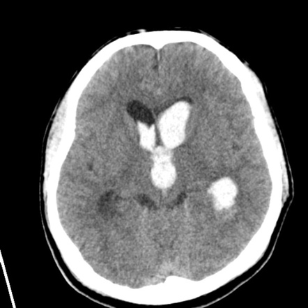 Playlist 'intraventricular Hemorrhage' By Dr Sherif Mohsen