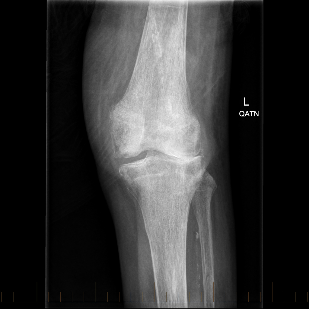 Proximal Fibula Fracture