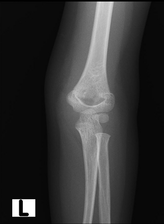 Supracondylar fracture | Image | Radiopaedia.org