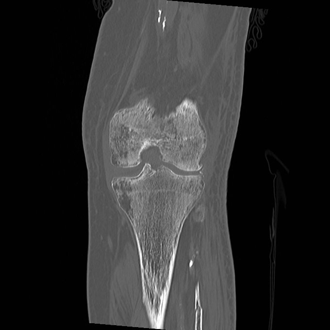 Proximal fibular fracture | Image | Radiopaedia.org