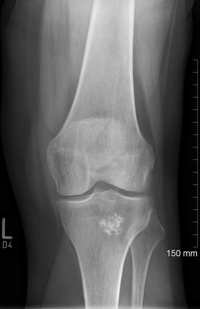 File:Enchondrom Tibia 83jm - Roe ap und seitlich - 001.jpg - Wikimedia  Commons