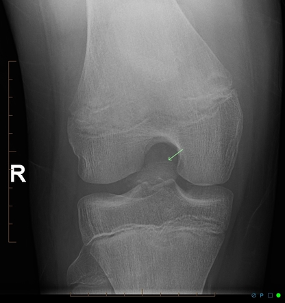 Avulsion tibial eminence - ACL origin | Image | Radiopaedia.org