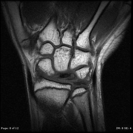 Osteonecrosis | Radiology Reference Article | Radiopaedia.org