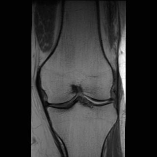 Bovine transplant of the lateral meniscus | Image | Radiopaedia.org