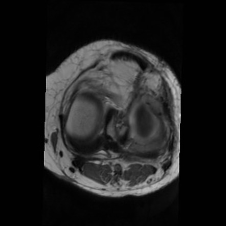 Bovine transplant of the lateral meniscus | Radiology Case ...