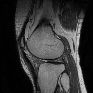 Bovine transplant of the lateral meniscus | Image | Radiopaedia.org