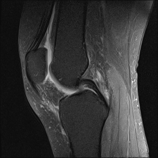 Bovine transplant of the lateral meniscus | Image | Radiopaedia.org