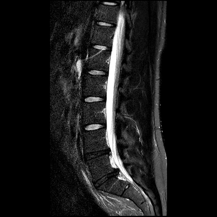 List 100+ Images Mri Images Of Herniated Disc L5-s1 Updated