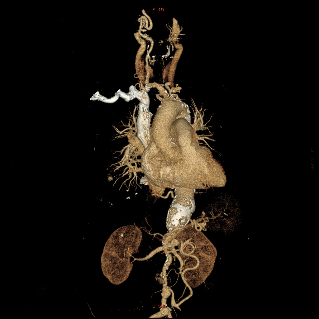 Takayasu's arteritis (pulseless disease) | Image | Radiopaedia.org