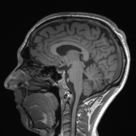 Dysembryoplastic neuroepithelial tumour (DNET) - cerebellum | Radiology ...