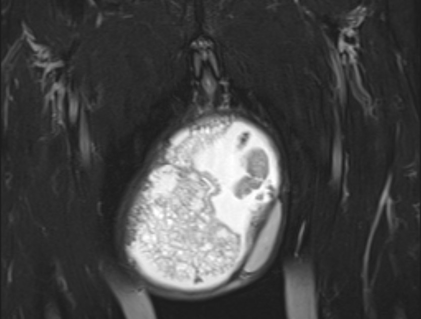 Testicular Rupture Image